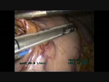 Laparoscopic/Thoracoscopic Esophagectomy