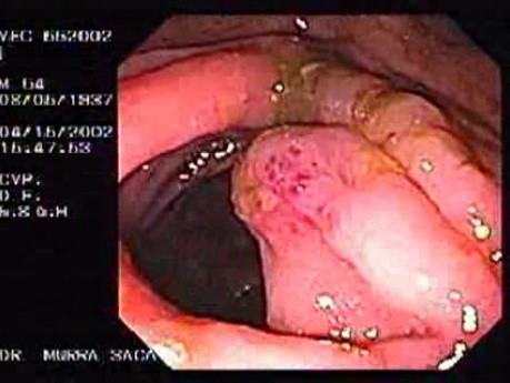 Zollinger- Ellison Syndrome - Gastric Ulcer with Gastrocolic Fistula (6 of 21)