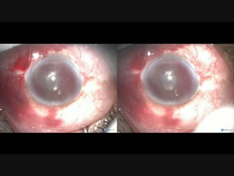 MTF in Neovascular Glaucoma - Bleeding During Surgery