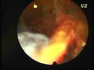 Hysteroscopic Aspect Of Trophoblastic Retention