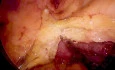 Laparoscopic Sigmoid Resection with Vena Cava Patch Resection for T4 Sigmoid Cancer