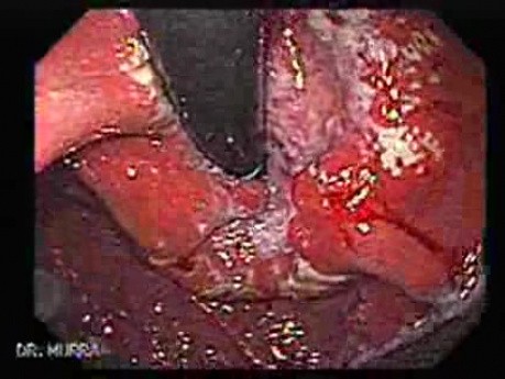 Adenocarcinoma of the Cardia and Fundus with Signet Ring Cells (2 of 5)