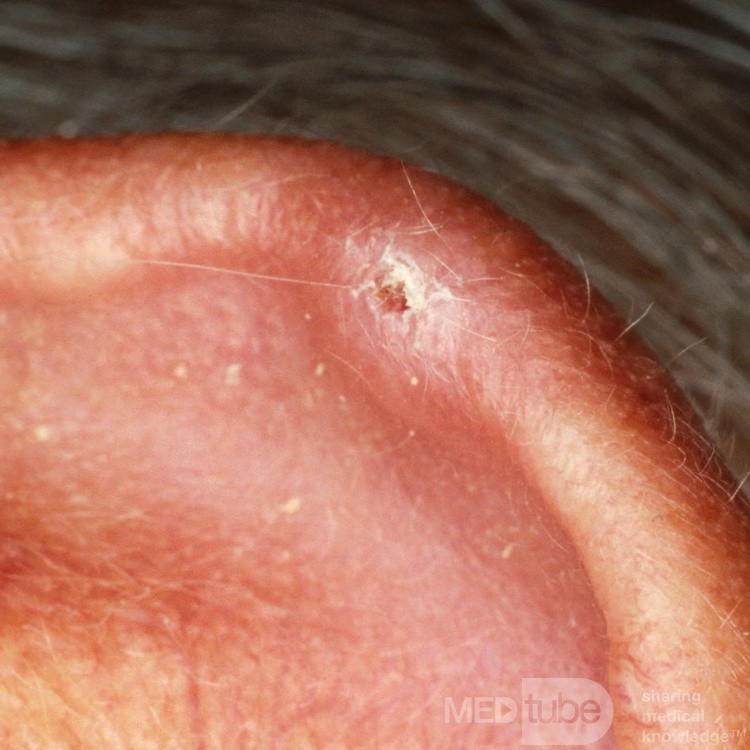 Chondrodermatis Nodularis Helicus Chronica [Winkler's Nodule]