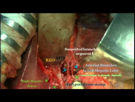 Left Hepatectomy For Hepatocellular Carcinoma 
