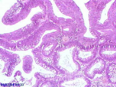 Sessile Tubulovillous Adenoma  (12 of 13)