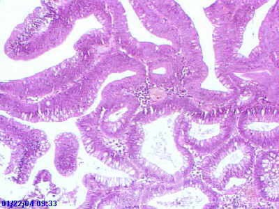 Sessile Tubulovillous Adenoma  (12 of 13)