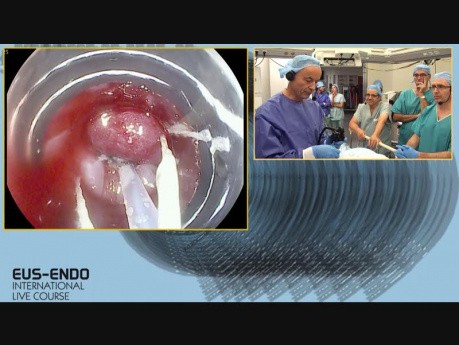 Endoscopic Resection - Discussion: ESD or CAP EMR?