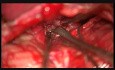 Pineal Region Tentorial Meningeoma