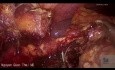 Laparoscopic Right Hemicolectomy for Perforated Diverticulitis