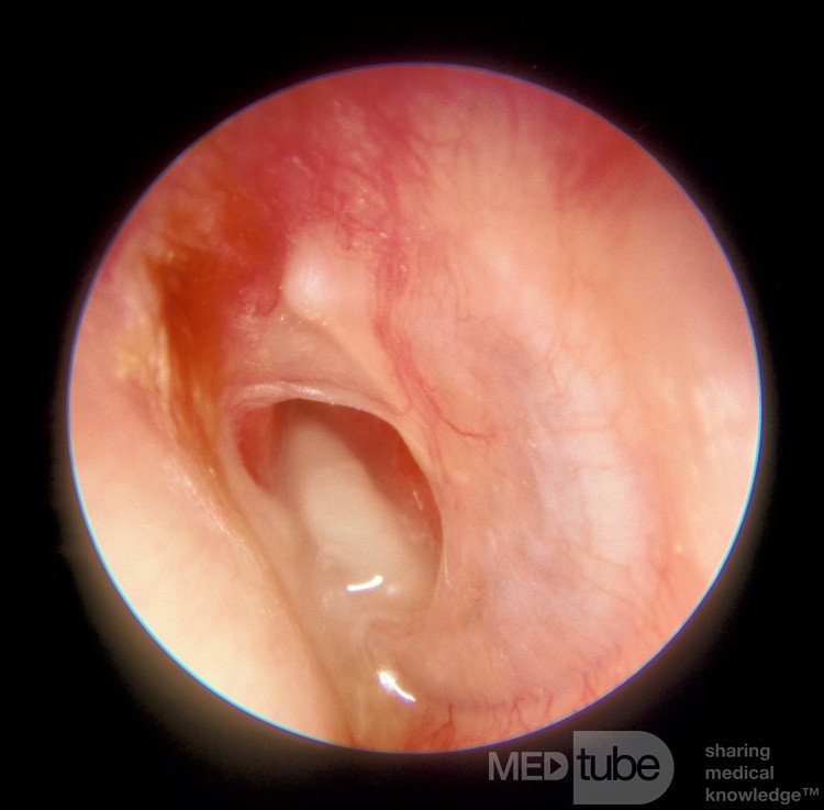 Chronic Suppurative Otitis Media (CSOM)