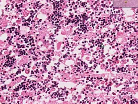 Erythroid hyperplasia - Histopathology - Bone marrow