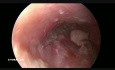 Endoscopic Butterfly Cartilage Myringoplasty
