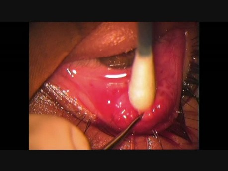 Unique Singh Technique of Ptosis Surgery - LPS Advancement, Intra-Orbital Approach