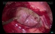 Laparoscopic Enterolysis Tina Hydrosalpingx