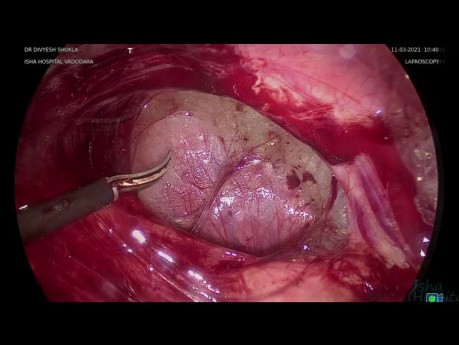 Laparoscopic Enterolysis Tina Hydrosalpingx