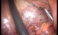 LESS Cholecystectomy with Concomitant Supracervical Hysterectomy without General Anesthesia