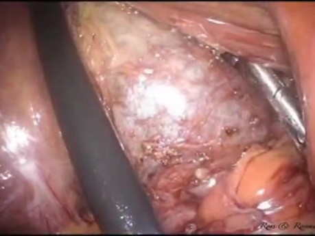 LESS Cholecystectomy with Concomitant Supracervical Hysterectomy without General Anesthesia