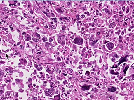 Neoplasia - MSP - 7d