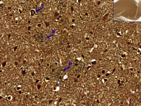 Alzheimer disease - Histopathology - Brain