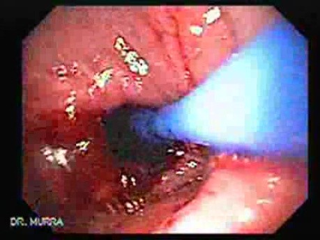 Esophagus - Pneumatic Dilation for Achalasia - Balloon Observed from the Stomach