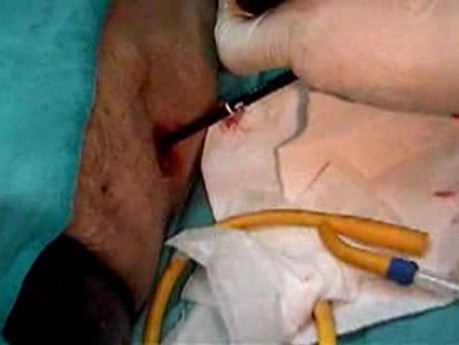 Entering Of The Endoscope Into The Gastrostomy Fistula