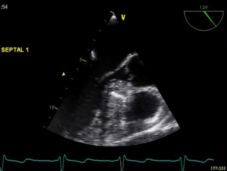 Treatment for Hypertrophic Obstructive Cardiomyopathy - Alcohol Septal Ablation
