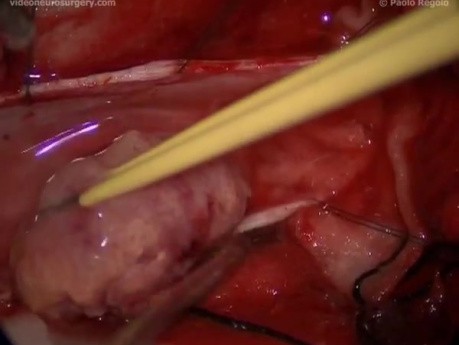 Thoracic Meningioma - Posterior Approach