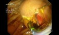 Papillary Tumor Exposed  