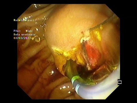 Papillary Tumor Exposed  