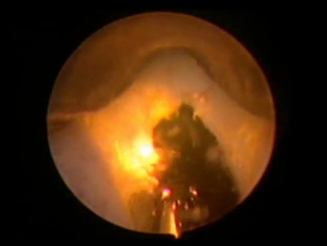 Greenlight HPS Prostatectomy