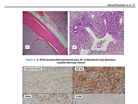 Coexistence of Gastric Gastrointestinal Stromal Tumor and Ulcerative Colitis in Patient with Dyspepsia and Rectorrhagia: A Case Report