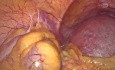 Laparoscopic Cervical Encerclage at 14 Week Pregnancy in c/o Boh, IVF Fail