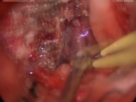 MCF Meningioma - Left Subtemporal-Pterional Approach