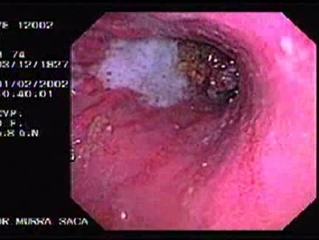 Carcinoma of the Gastric Body - Endoscopy