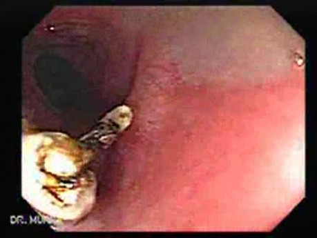 Colonoscopic Polypectomy (16 of 18)