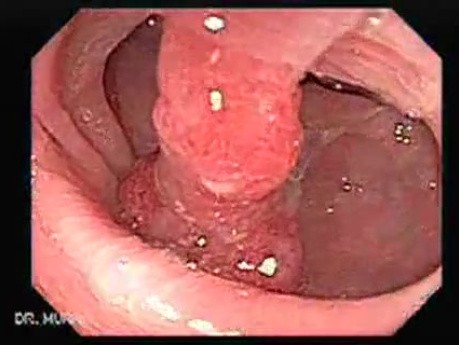 Endoscopic Appearance of Pedicled Polyp of the Descending Colon (1 of 7)