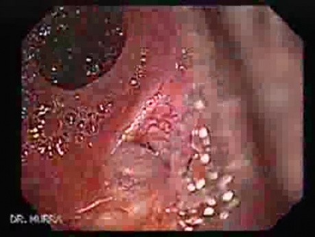 Ileal Neobladder Substitution (ileal bladder) (4 of 9)