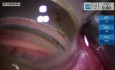 Glaucoma Microstent Implant into the Superior Quadrant