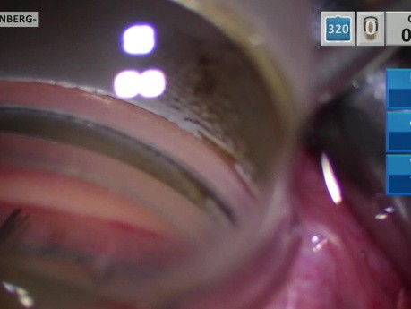 Glaucoma Microstent Implant into the Superior Quadrant