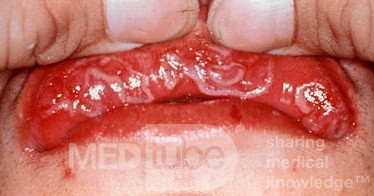 Syphilis [secondary mucus patches of the lip]