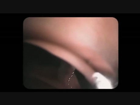 Endoscopic Signs Of Cancer In a Flat Lesion 