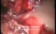 Cystogastrostomy - Laparoscopic Approach