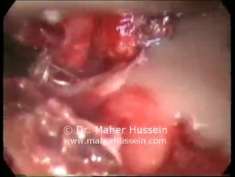 Cystogastrostomy - Laparoscopic Approach
