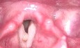 Vocal Fold Mucosal Cyst