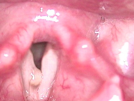 Vocal Fold Mucosal Cyst