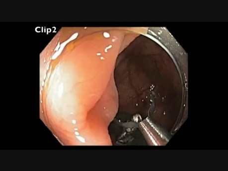 Colonoscopy Channel - Cecal EMR In A Patient With Liver And Colon Surgery
