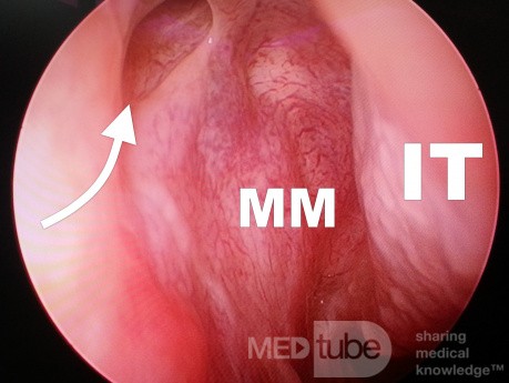 Patulous End of The Nasolacrimal Duct
