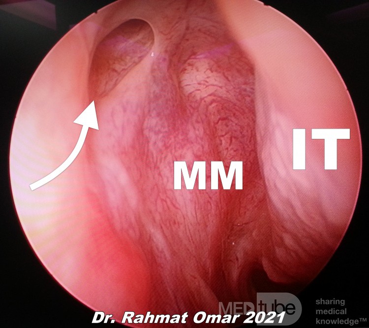 Patulous End of The Nasolacrimal Duct