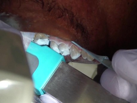 CEREC #3 Intral Oral