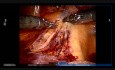 Robotic Right Upper Lobectomy